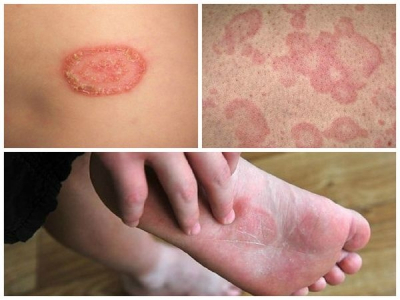 Ихтиоз (врожденный, вульгарный, арлекина): тяжелое заболевание кожи