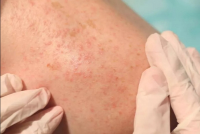 Лишай Жибера: причины, симптомы и эффективные методы лечения