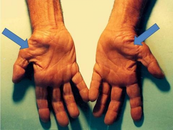 Онемение пальцев: что может скрывать этот тревожный симптом?